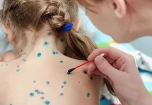 На Полтавщині відступає ГРВІ, але виникла загроза епідемії вітряної віспи