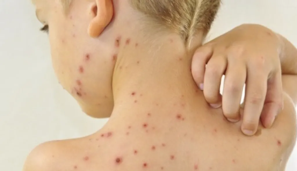 Спалах кору зафіксували на Полтавщині