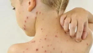 Спалах кору зафіксували на Полтавщині