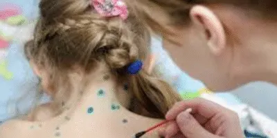 На Полтавщині фіксують спалах вітряної віспи