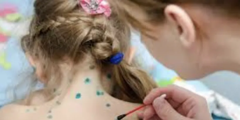 На Полтавщині фіксують спалах вітряної віспи