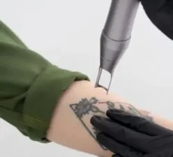 Видалення татуювання піко-секундним лазером Pico-Light 10 в студії DULIOR