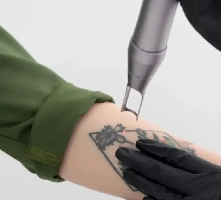 Видалення татуювання піко-секундним лазером Pico-Light 10 в студії DULIOR